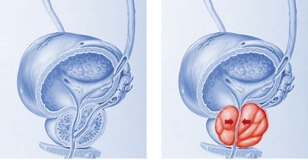 zdravá a zapálená prostata s prostatitídou